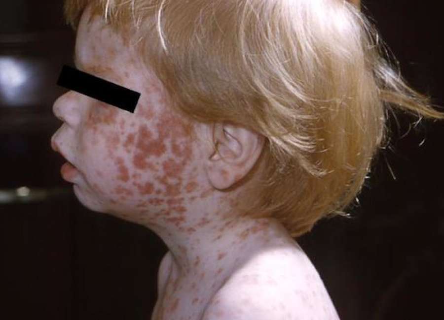 90 new cases of measles reported in one week