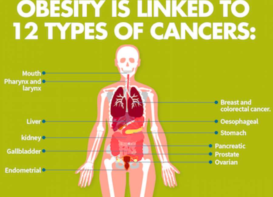 Obesity linked to 12 types of cancer